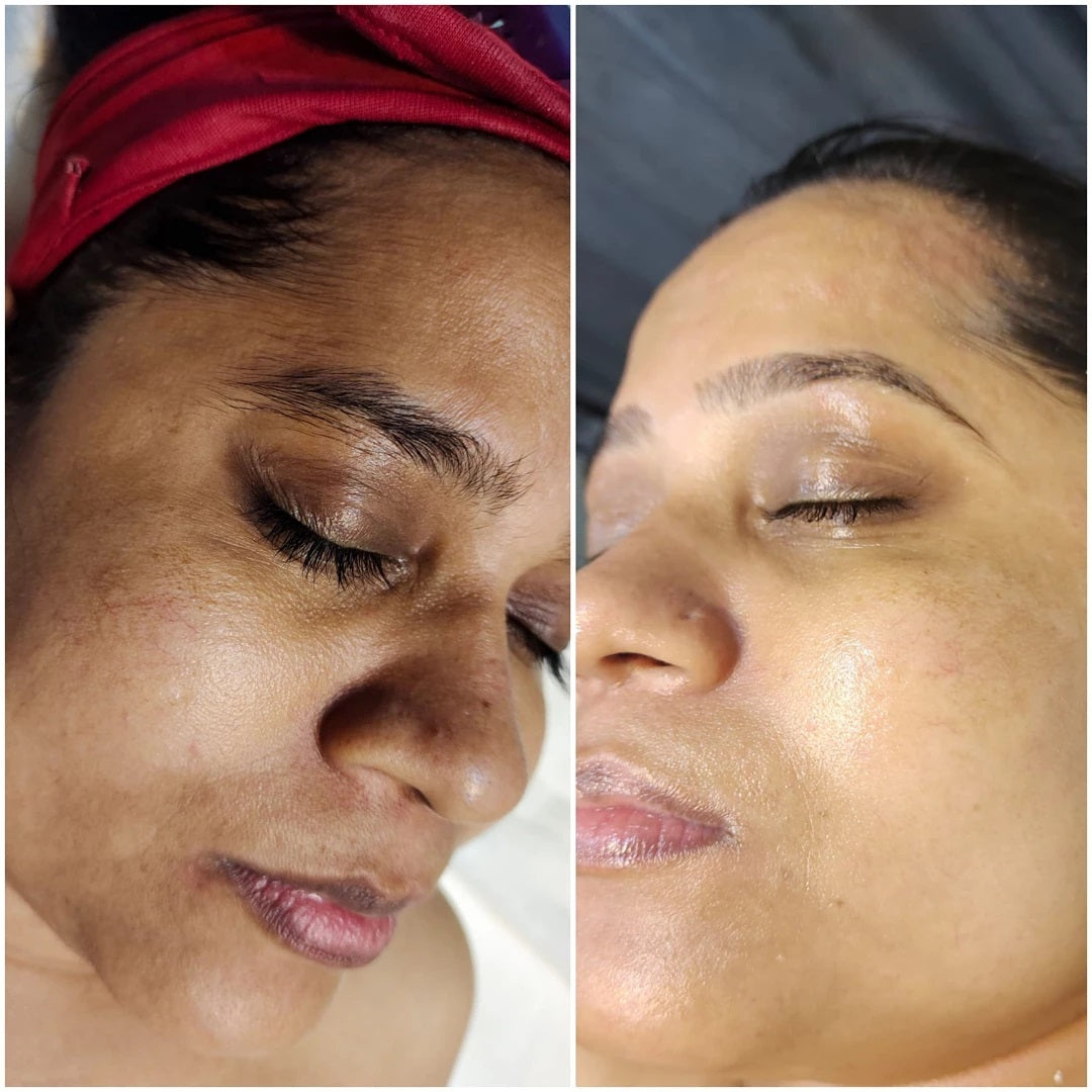(🔥LAST DAY SALE-80% OFF)-Fast Dark Spot Remover-NESLEMY  Turmeric Spot Repair Serum