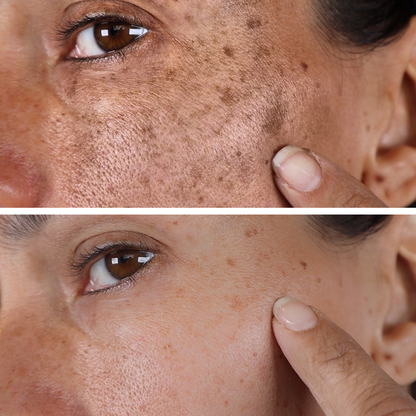 (🔥LAST DAY SALE-80% OFF)-Fast Dark Spot Remover-NESLEMY  Turmeric Spot Repair Serum