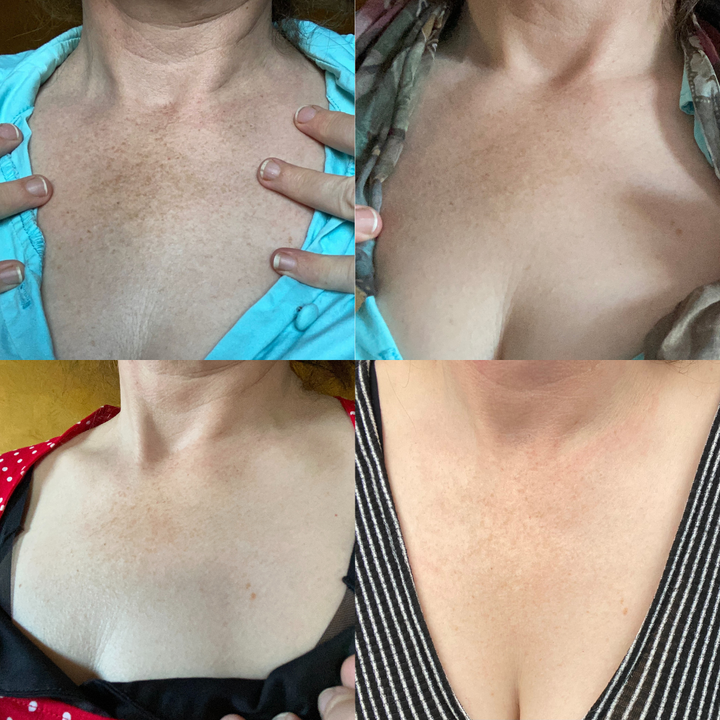 (🔥LAST DAY SALE-80% OFF)-Fast Dark Spot Remover-NESLEMY  Turmeric Spot Repair Serum