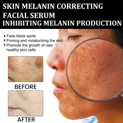 (🔥LAST DAY SALE-80% OFF)-Fast Dark Spot Remover-NESLEMY  Turmeric Spot Repair Serum